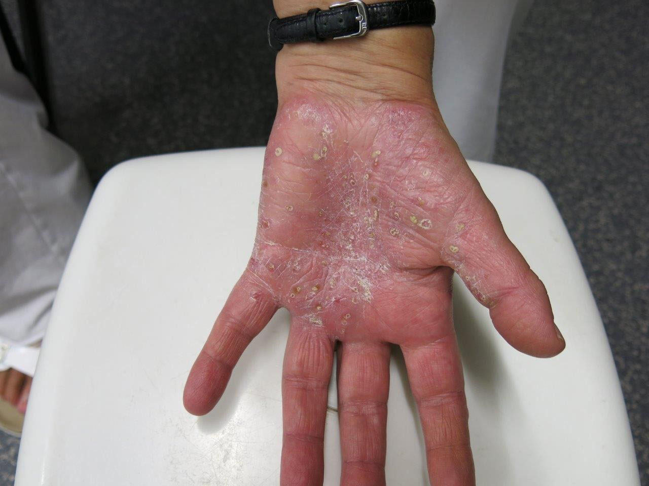 Viele Formen Viele Behandlungsmoglichkeiten Dermaforum Zeitung Fur Dermatologie Und Allergologie