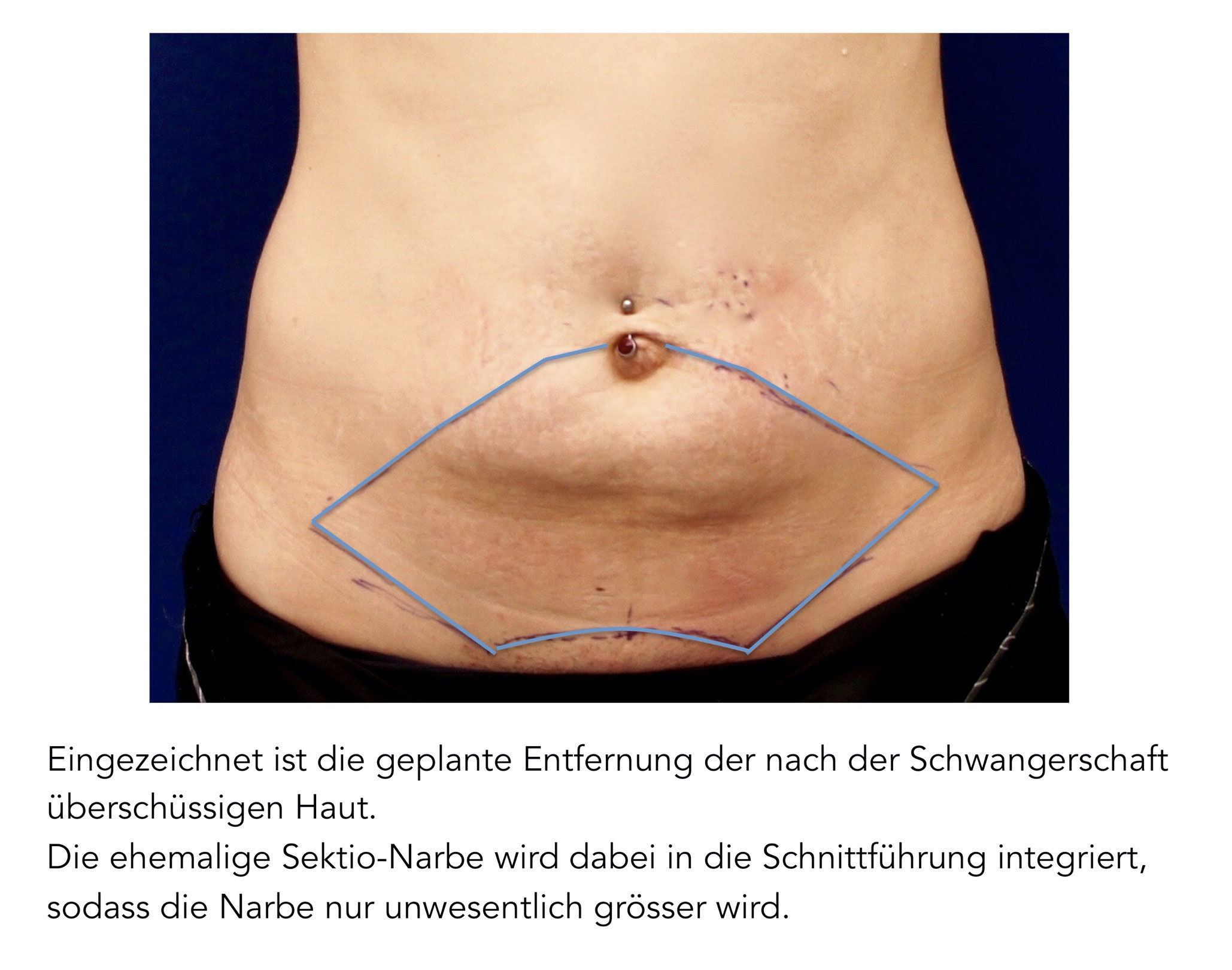 Starke Entzündung In Der Bauchfalte www.bellemedic.ch