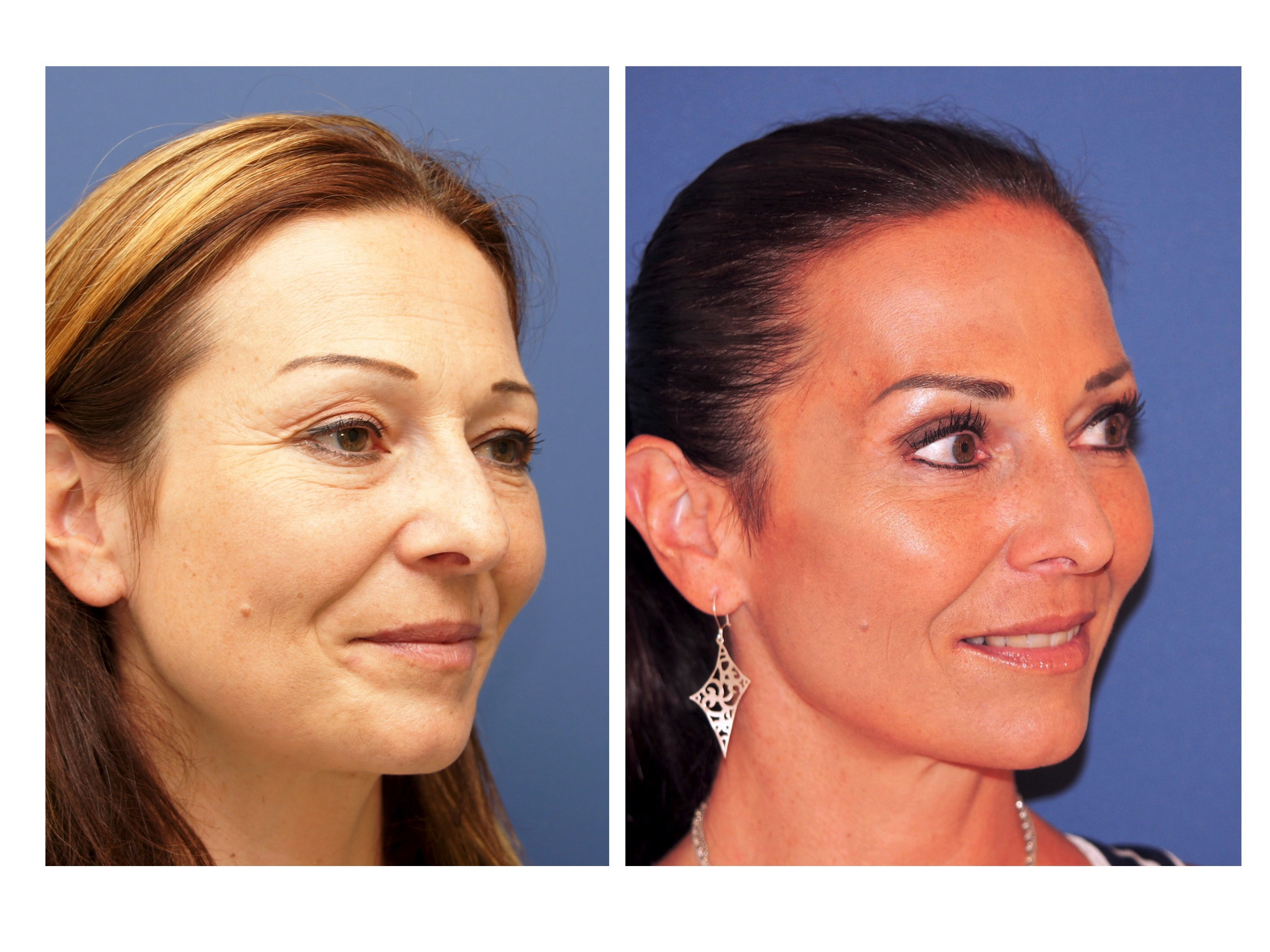 Botulinumtoxin / Botox , Krähenfüsse, Zornesfalten, Faltenbehandlung Schönheitsklinik Luzern