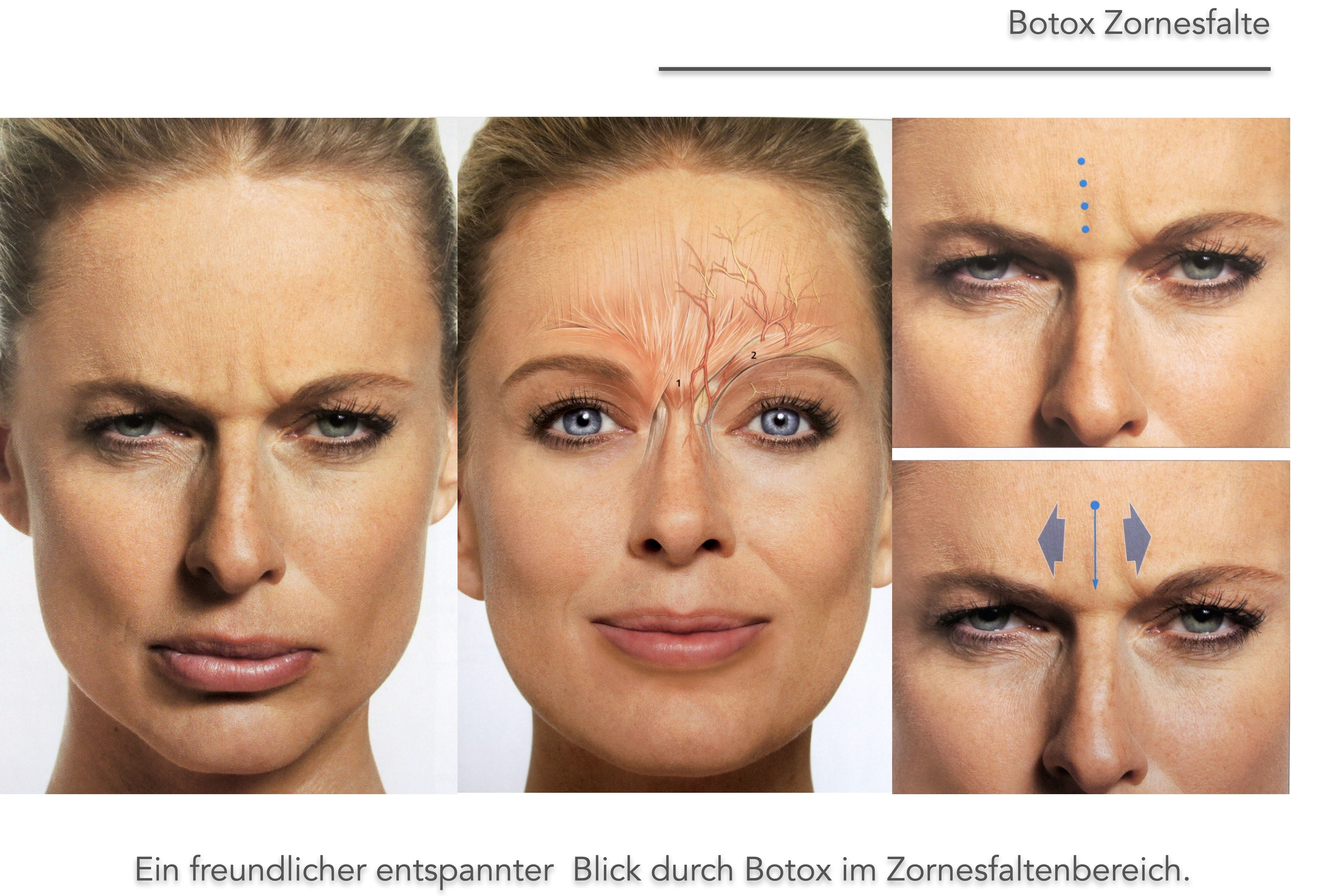 Botulinumtoxin / Botox , Krähenfüsse, Zornesfalten, Faltenbehandlung Schönheitsklinik Luzern