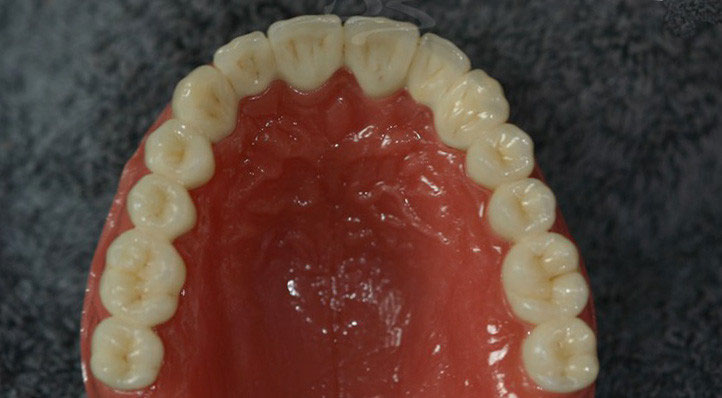 Beispiele Fur Festsitzenden Und Herausnehmbaren Zahnersatz Dentallabor Detlef Bohm In Munchen