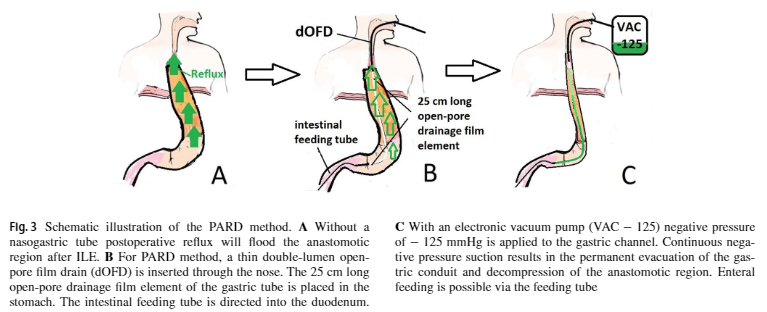 endoscopic-vacuum-therapy-evt-endoscopicvacuumtherapys-webseite