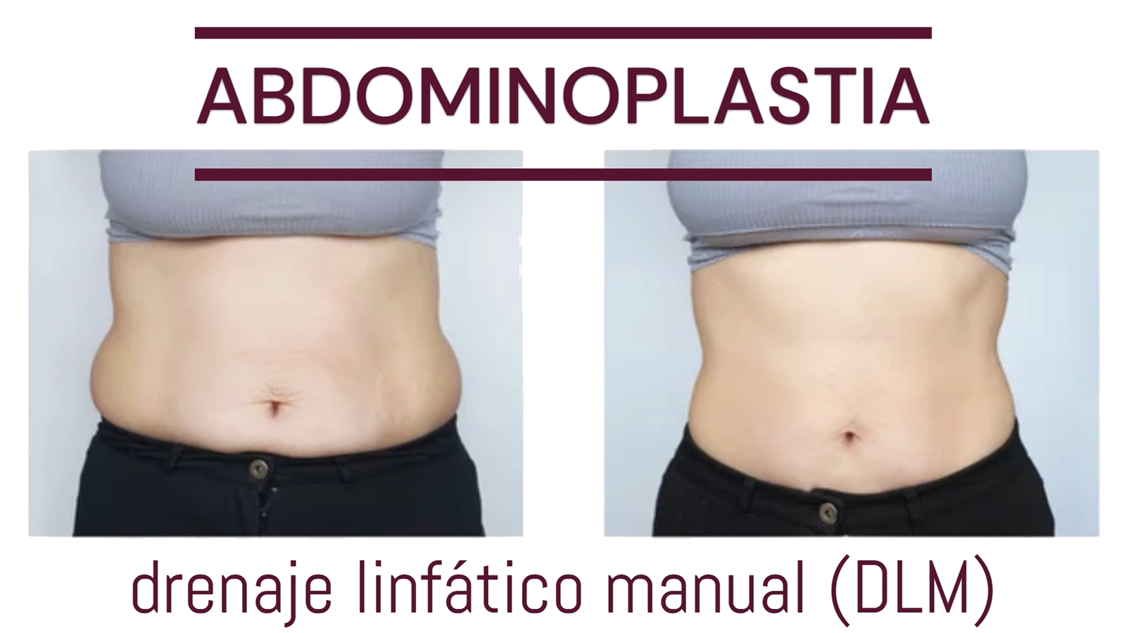 Fascia Addominale Vitalymph Per Drenaggio Linfatico – Manicotto Per Terapia Di Compressione Adatto A Casa E Fisioterapia, Taglie M E L - 5