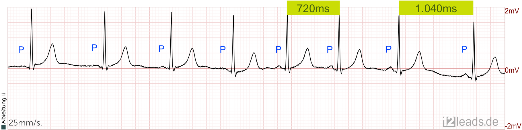 Respiratorische Sinusarrhythmie Herzkurven