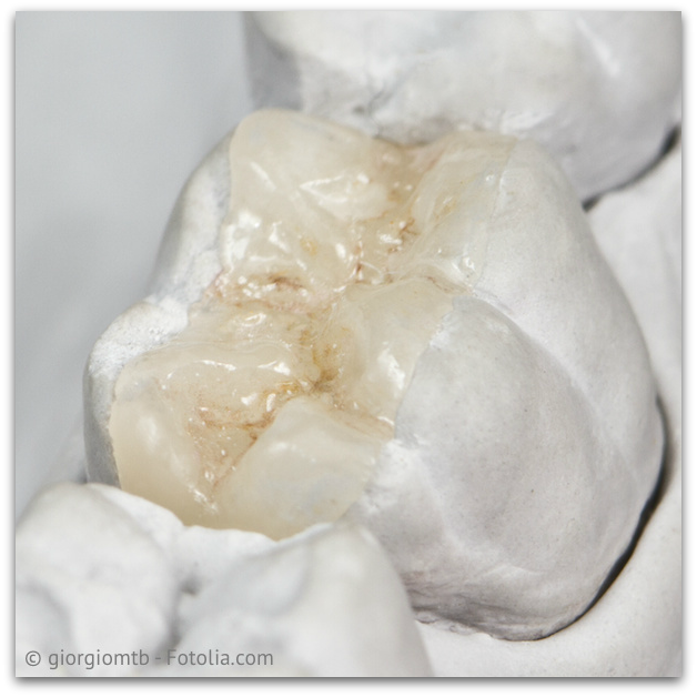 Alternativen zum Amalgam Zahnarzt Balingen