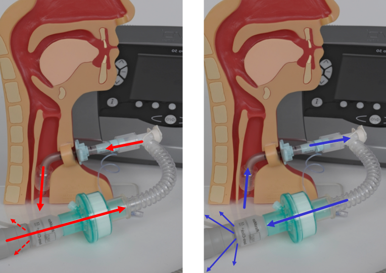 Sprechventile und Schlucken - Dysphagie Schweiz Suisse