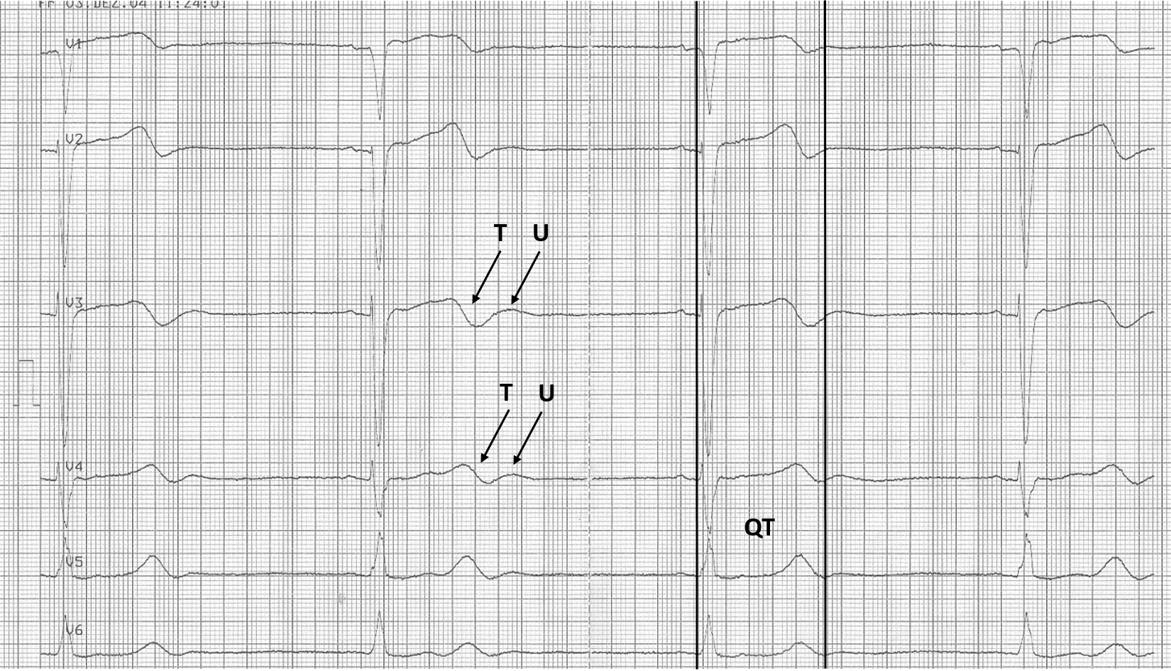 EKG bei Elektrolytstörungen - Fokus-EKG