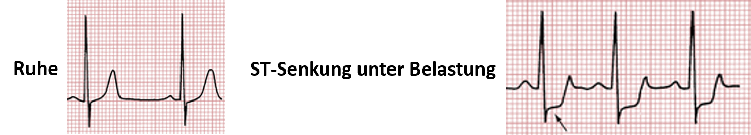 Wieviel Watt Sollte Man Beim Belastungs Ekg Schaffen Ischämierdiagnostik mittels Belastungs-EKG - Fokus-EKG