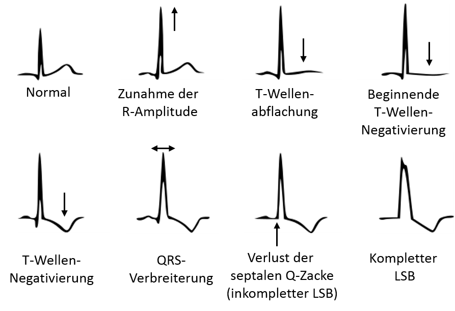 Linksventrikuläre Hypertrophie - Fokus-EKG