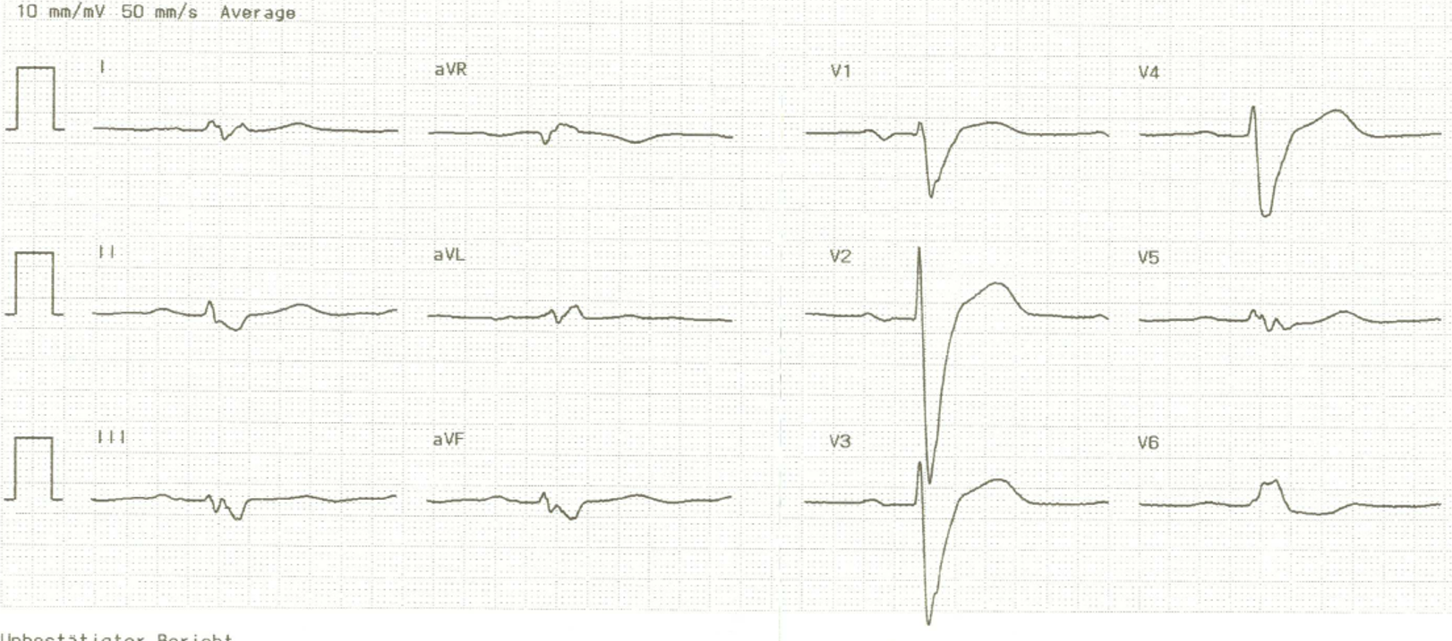 Linksschenkelblock im EKG FokusEKG