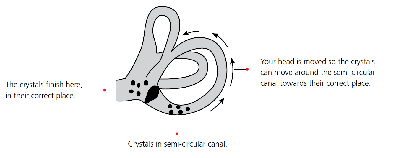 Benign paroxysmal positional vertigo