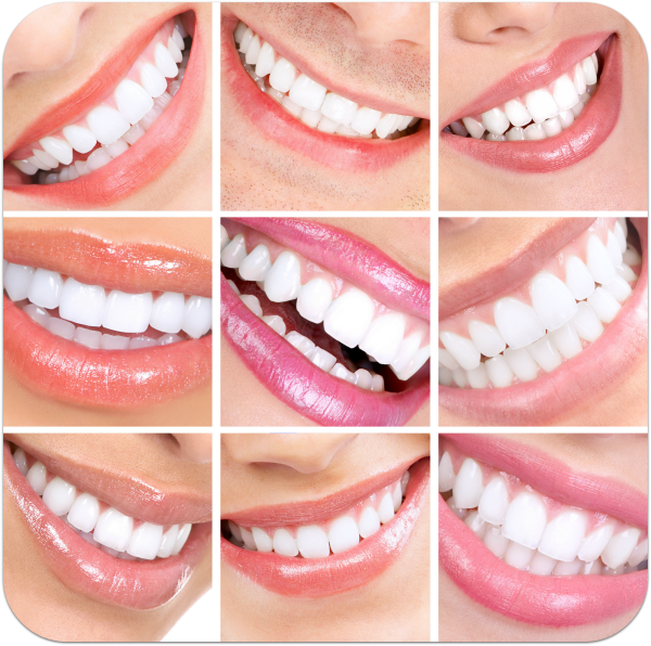 Veneers Keramikverblendschalen Zahnarzt Dr Goedecke Osnabruck