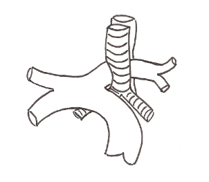 Schéma d'une artère pulmonaire gauche retro-trachéale