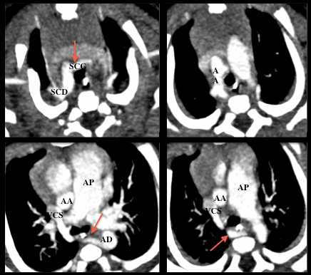 Anomalies des troncs supra-aortiques - Imagerie des malformations ...