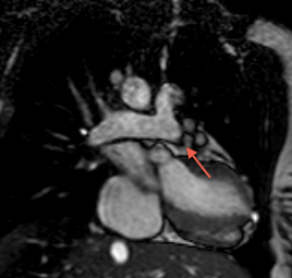 Aspect caractéristiques en "mouette" des AP en coupe coronale oblique d'IRM. La confluence des AP est parfaitement identifiée.