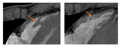Aspect du VD en IRM. Bandelette modératrice et trabéculations multiples ( flèches oranges)