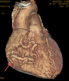 Exemple de fistule coronaro-camérale droite en reconstruction VR d'un scannere