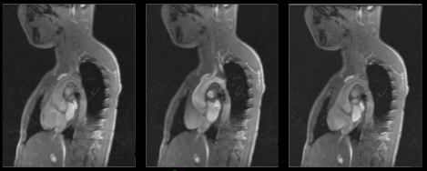 Coupa sagittale oblique déroulant l'arche aortique montrant une coarctation en diaphragme en IRM.