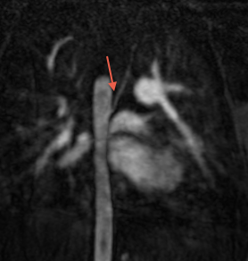 Collatérales aorto-pulmonaires en angio-IRM en coupe coronale.