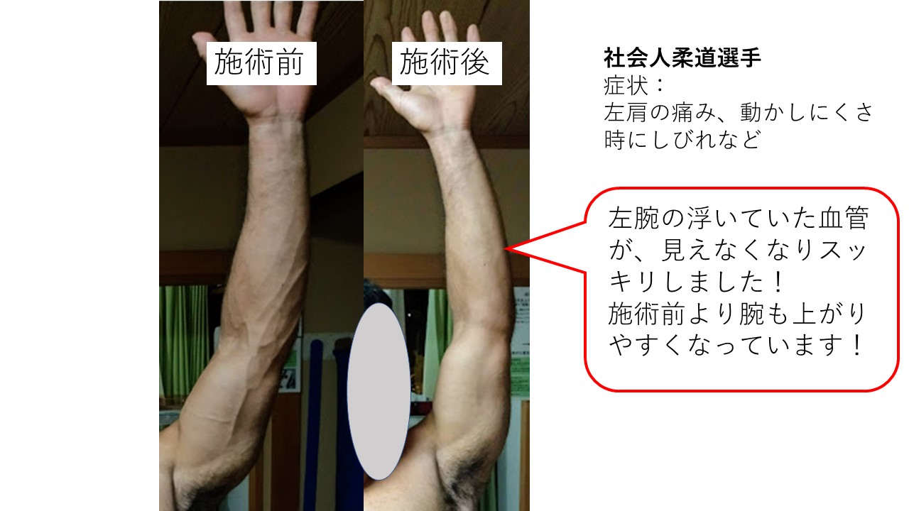胸郭出口症候群 Tos 疑いの柔道選手 肩こり 五十肩専門治療院 胸郭出口症候群 Tos 疑いの柔道選手 肩こり 五十肩専門治療院