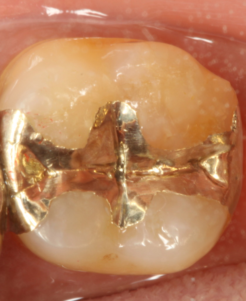 神田 歯科ブログ ゴールドインレー - 神田ふくしま歯科