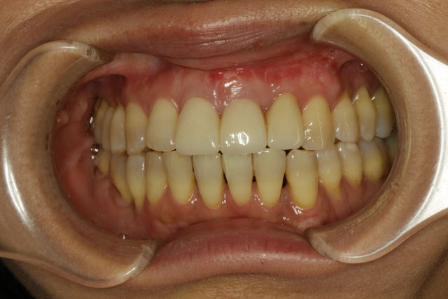 セラミックの長さを短くしたケース　治療後