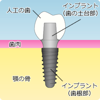 神田ふくしま歯科のインプラント