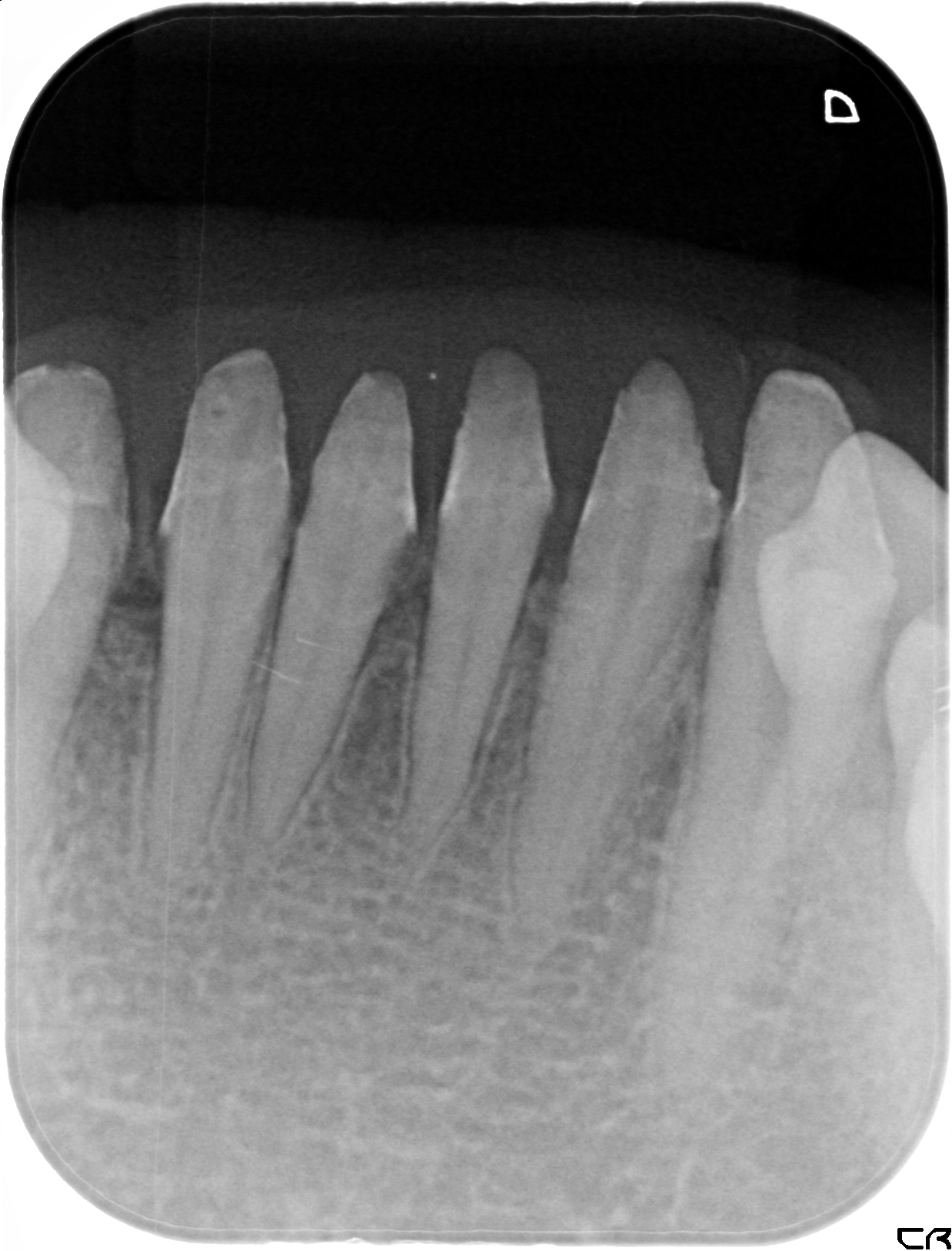 骨の再生治療後　仮歯で歯の揺れの固定中
