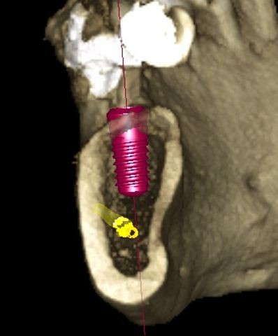 3D Bild des gesetzten Implantates (Gelb ist der Nerv)