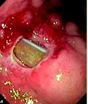 duodenal perforation caused from an operative drain