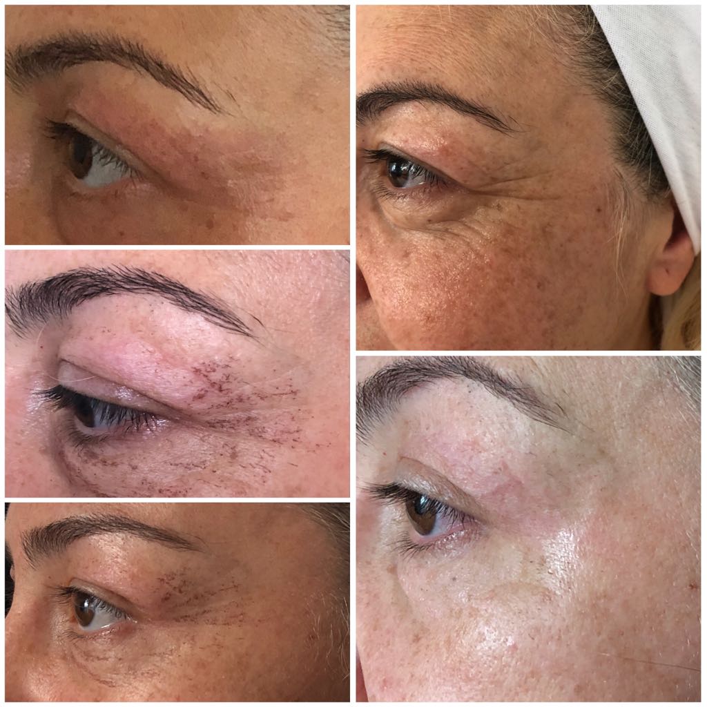 Plasma Pen Behandlung Carpe Diem Cosmetics Kosmetik Permanent Makeup Plasma Wimpern Beauty Plasma Pen Behandlung Carpe Diem Cosmetics Kosmetik Permanent Makeup Plasma Wimpern Beauty