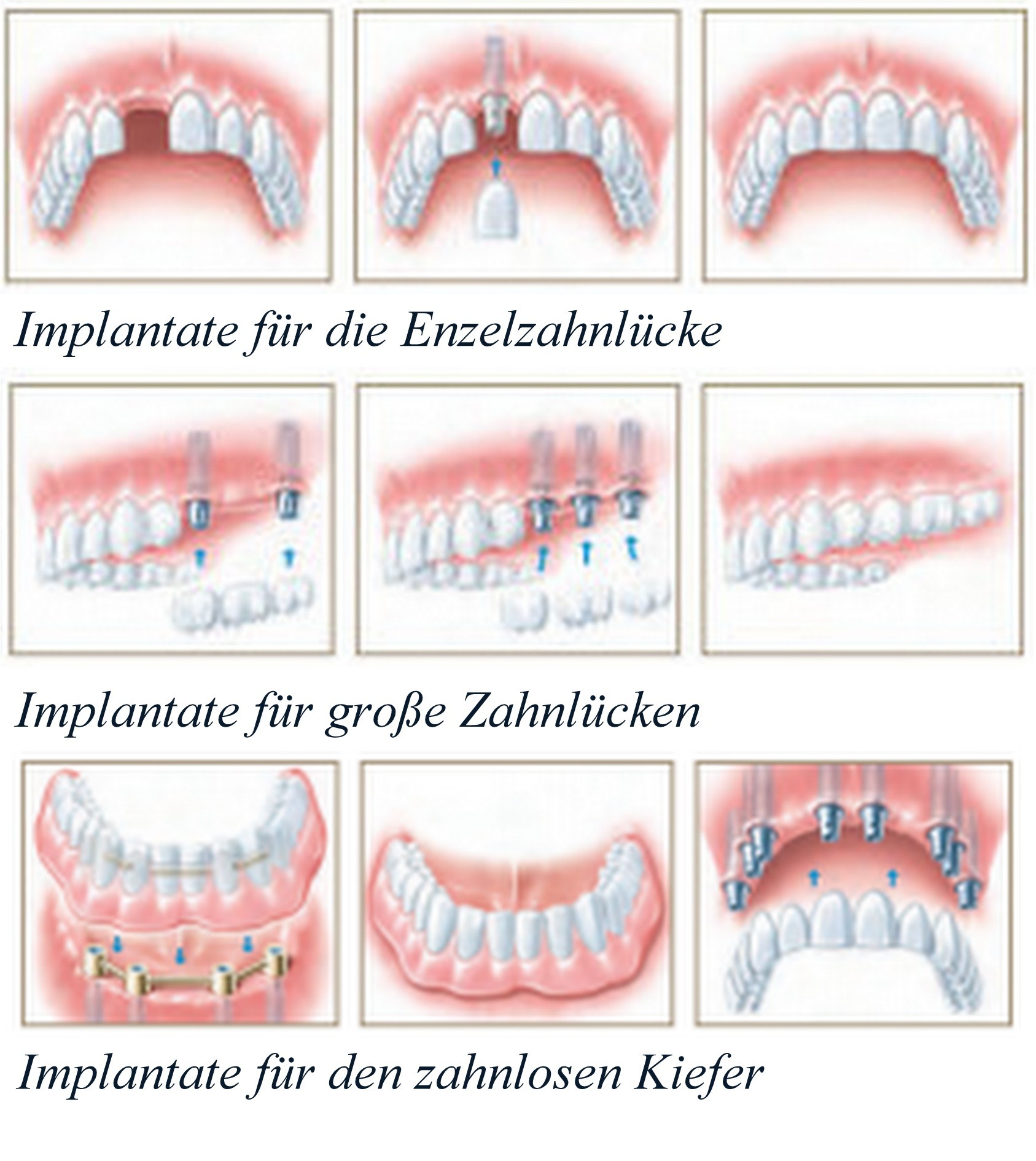 Hochwertiger Zahnersatz auch auf Implantaten Zahnarztpraxis Gadegast Ein Zahnarzt für die Hochwertiger Zahnersatz auch auf Implantaten Zahnarztpraxis Gadegast Ein Zahnarzt für die