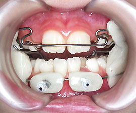 子ども 小児の矯正治療 東京渋谷 Cs矯正歯科クリニック 渋谷駅5分歯列矯正専門医院