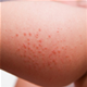 ALLERGIE