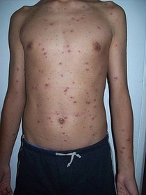 VARICELLA