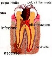 MAL DI DENTI