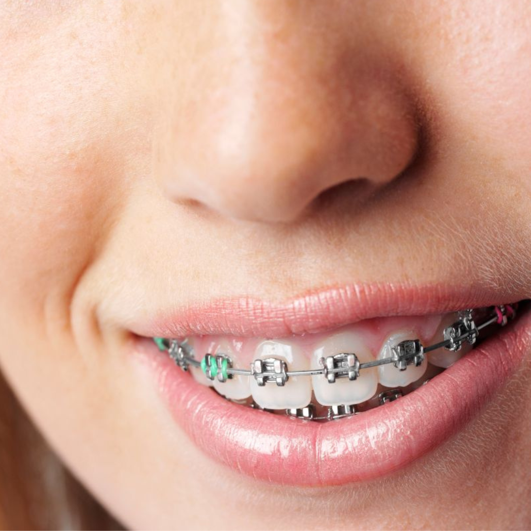 Zahnspangen- und Zahnschienenbegleitung mit R.E.S.E.T. TMJ®