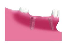 2 eingeheilte Implantate