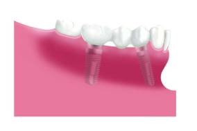 Dreigliedrige Brücke auf zwei Implantaten