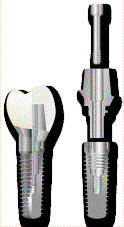 Mehrteiliges Implantat
