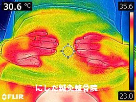 星状神経節レーザー照射後
