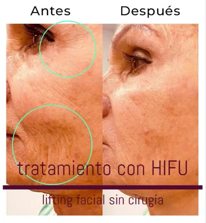 hifu lifting facial madrid