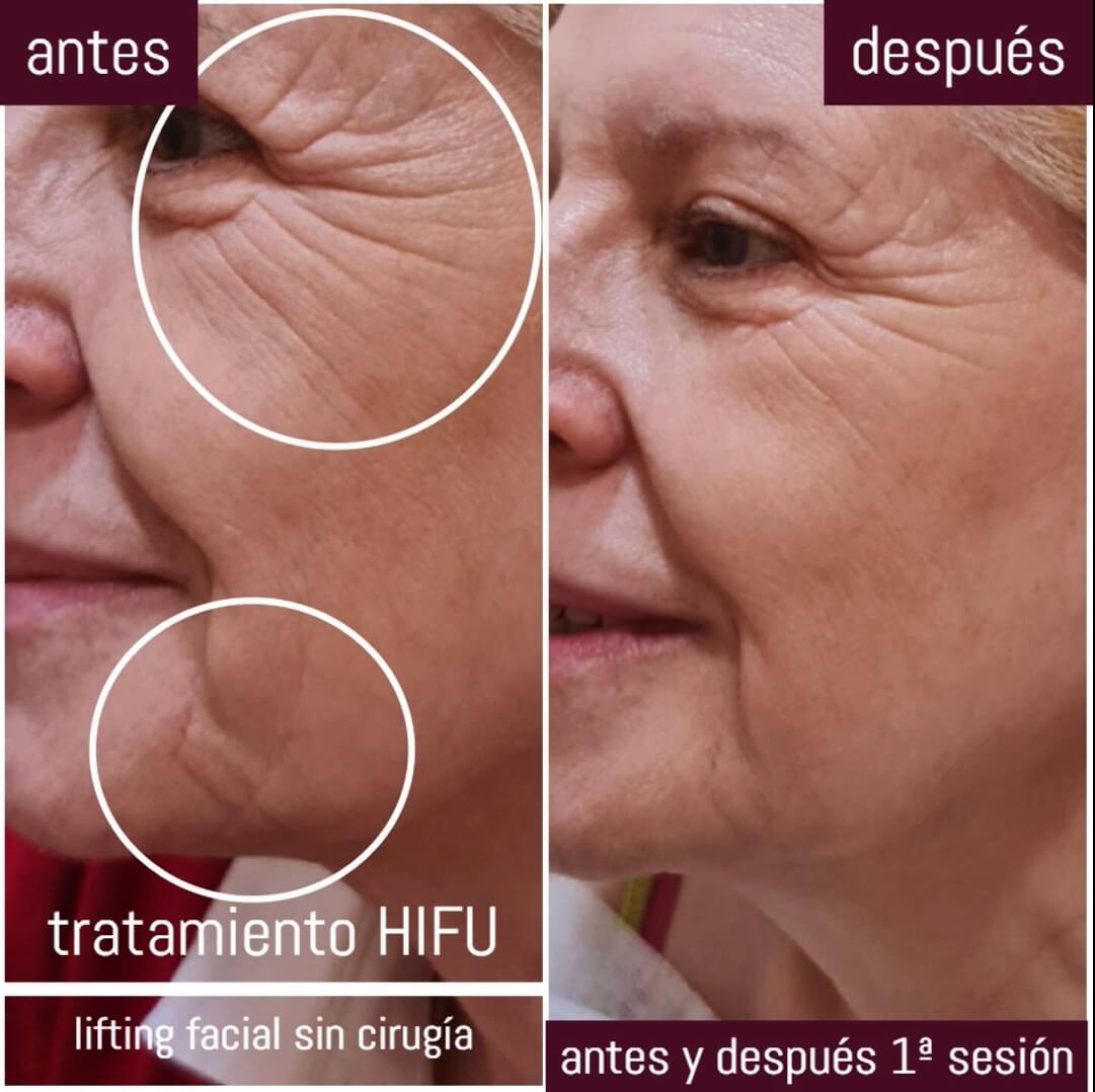 hifu facial antes y despues