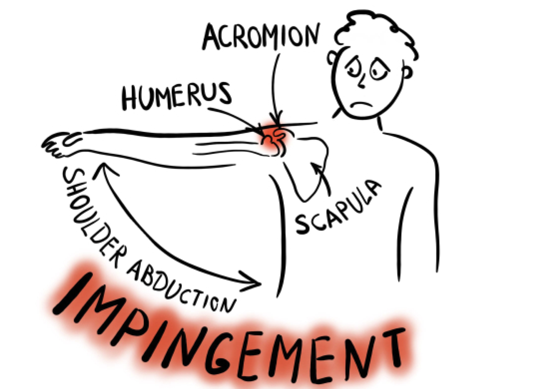 Schulterimpingement...einfach zu wenig Platz?