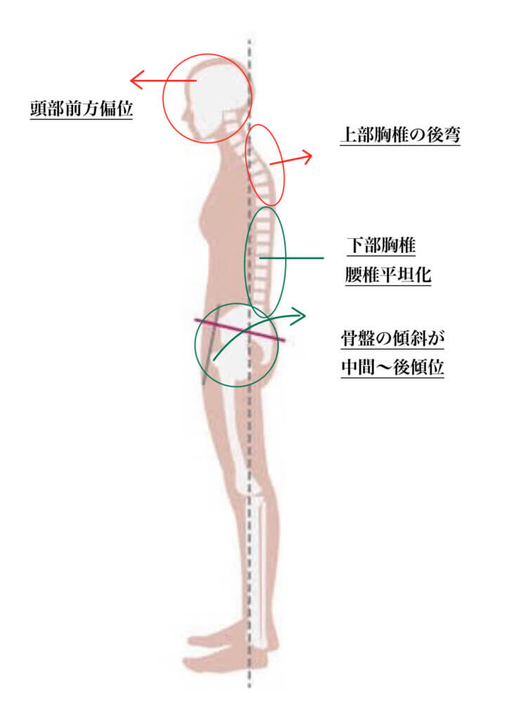 慢性腰痛のリスク「フラットバック」