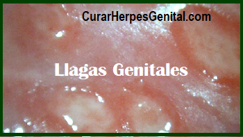 Curar Herpes Genital Tratamiento Natural Para El Herpes Genital