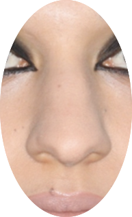 Example of a broad nose
