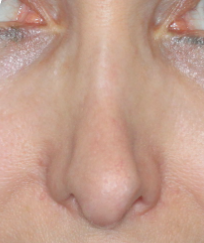 Voroperierte Nase mit Kollaps des Nasenrückens