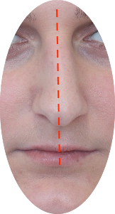 Example of a crooked nose