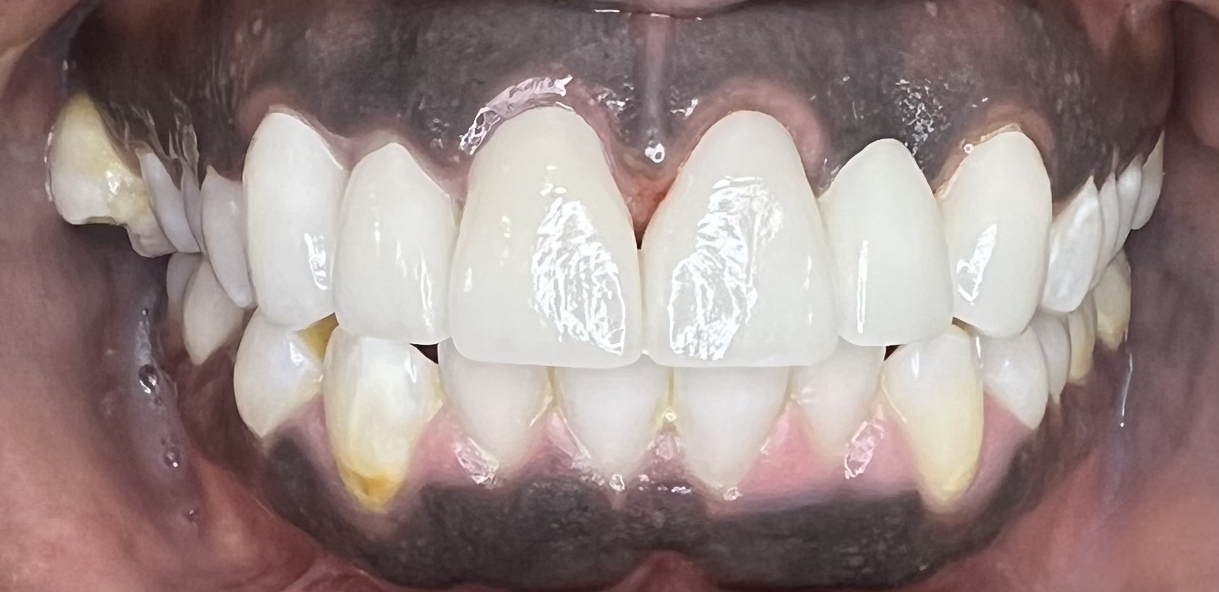 AFTER | Cosmetic crowns and bridges